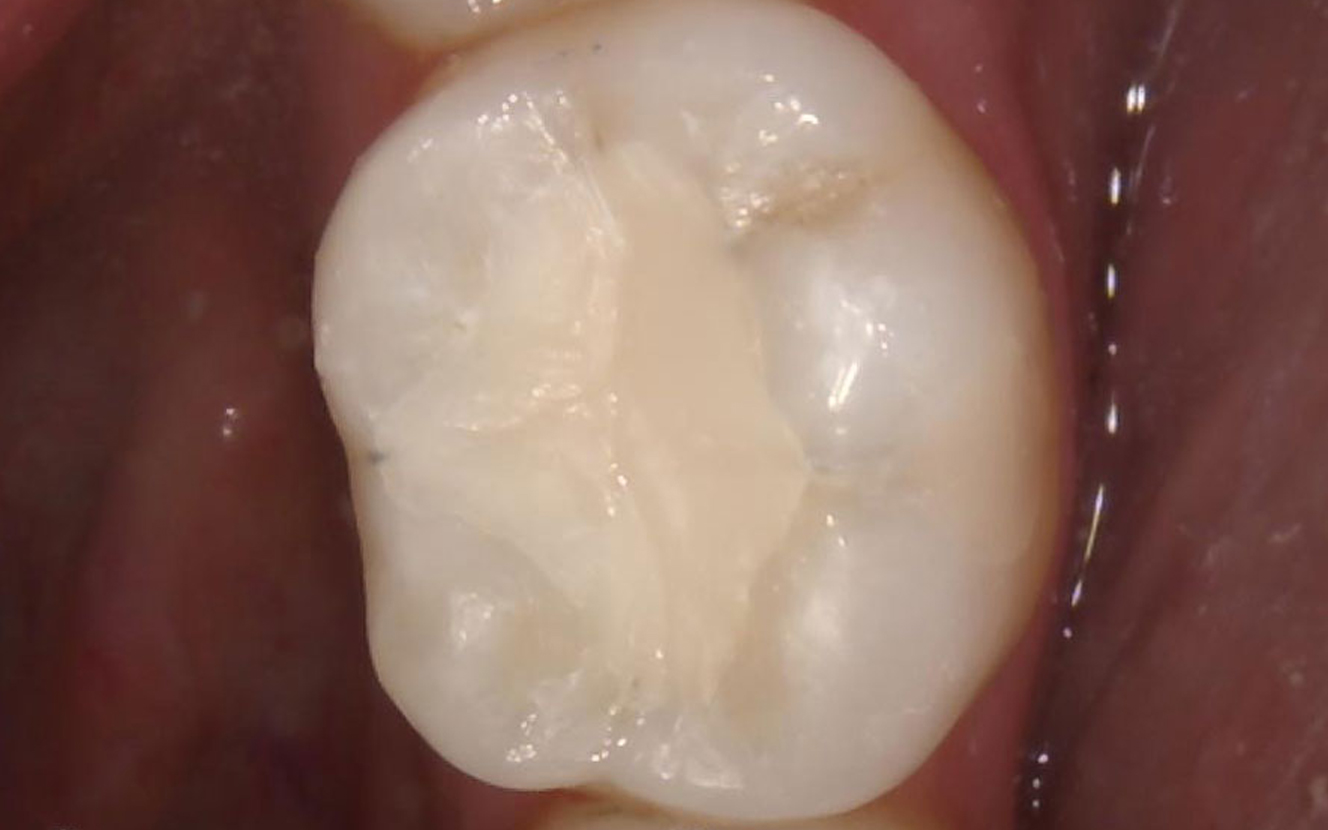 white fillings in Cork