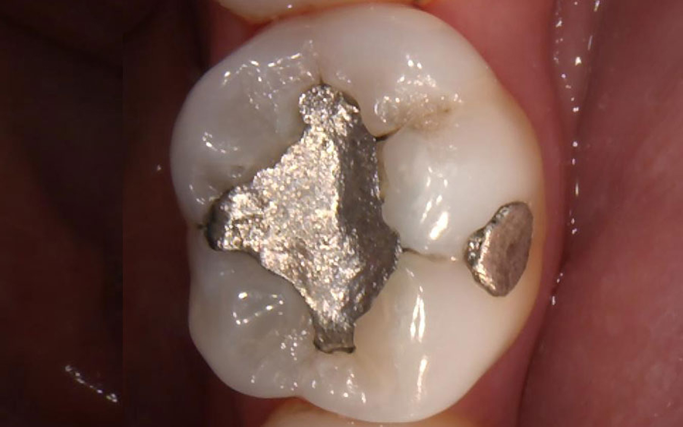 white fillings in Cork