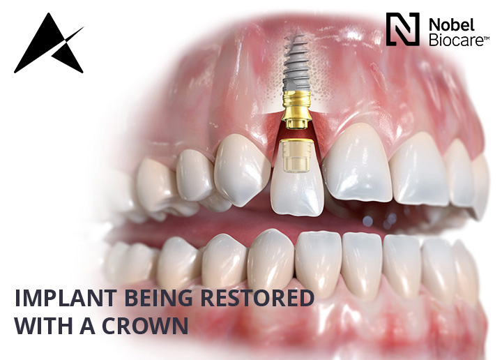 dental implants cork