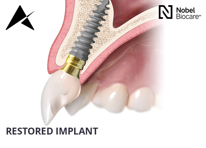 dental implants cork