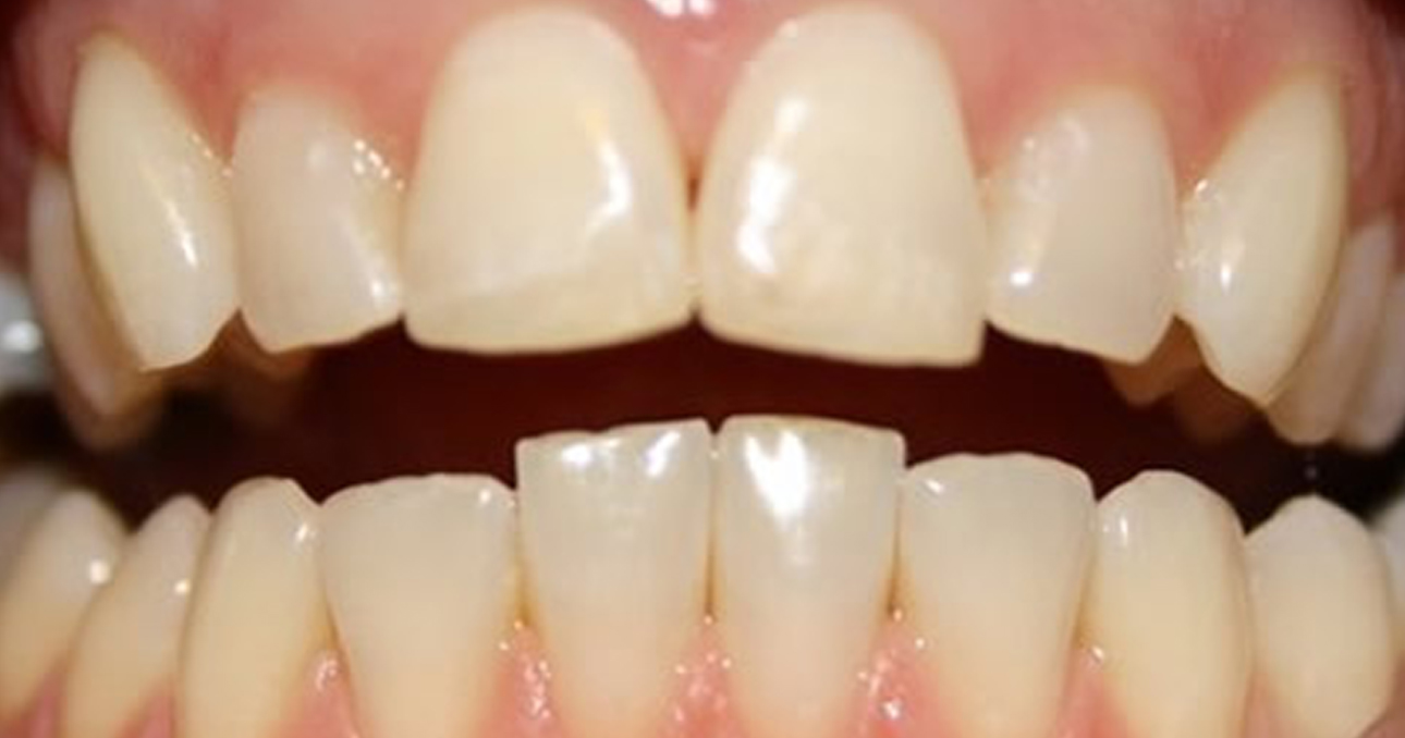 tooth whitening in Cork