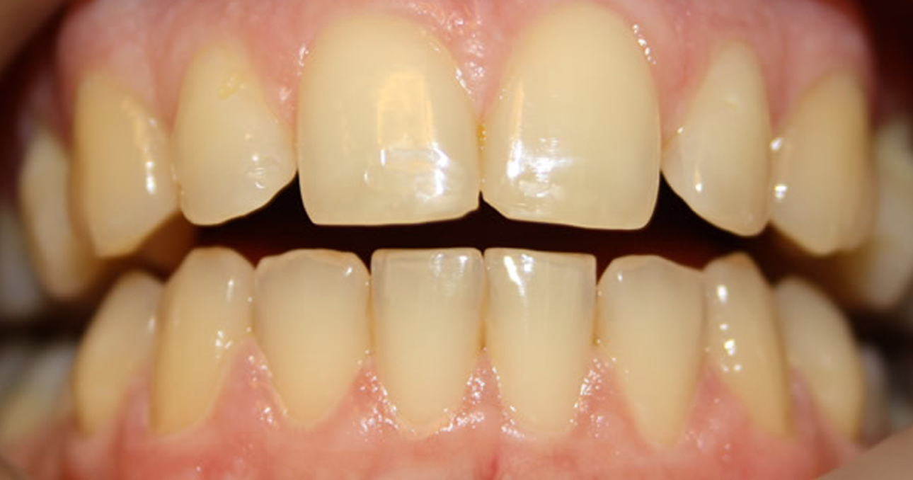 tooth whitening in Cork - Airport Dental Implant Centre Cork